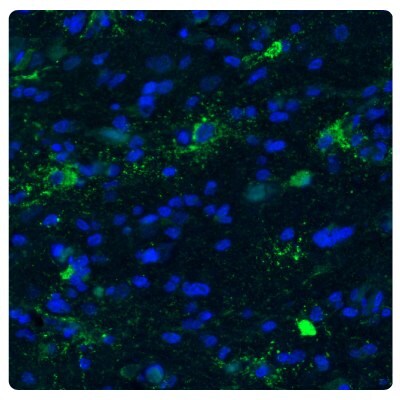 Immunostaining with fluorescence immunohistochemistry of astrocytoma samples stained with the Anti-CHI3L1 antibody (Product No. AMAb91777) showing strong protein expression in astrocytoma.