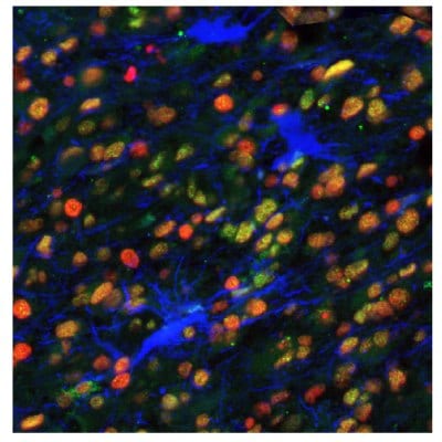 Multiplexed IHC-IF staining of astrocytoma using Anti-EZH2 monoclonal (Product No. AMAb91752), Anti-PARP1 monoclonal (Product No. AMAb90959), and Anti-ALDH1A3 monoclonal (Product No. AMAb91754) antibodies.