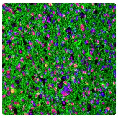 Multiplexed IHC-IF staining of astrocytoma showing ATRX and GFAP immunoreactivity in tumor cells. Anti-ATRX antibody (Product No. AMAB90784) and Anti-GFAP antibody (Product No. AMAB91033) were used.