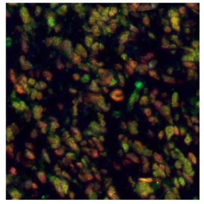 Multiplexed IHC-IF staining of glioblastoma using Anti-EZH2 monoclonal (Product No. AMAb91752), Anti-PARP1 monoclonal (Product No. AMAb90959), and Anti-ALDH1A3 monoclonal (Product No. AMAb91754) antibodies.