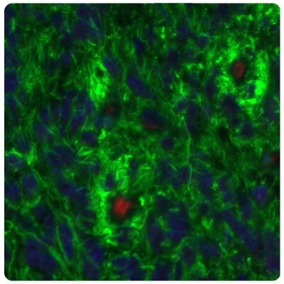 Multiplexed IHC-IF staining of glioblastoma samples using Anti-SALL4 monoclonal (Product No. AMAb91769) and Anti-PTEN monoclonal (Product No. AMAb91736) antibodies showing SALL4 upregulation.