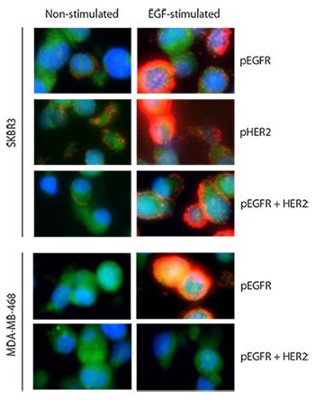 Two breast cancer cell lines, SKBR3 and MDA-MB-468, are assayed with Duolink before and after EGF treatment for three targets: pEGFR alone, pHER2 alone, and the complex pEGFR-HER2. Red: PLA signals. Green: Sample autofluorescence (to visualize the cell morphology). Blue: nuclei (DAPI). Images were taken pair wise with the same exposure time of EGF-stimulated and non-stimulated samples for each assayed analyte.