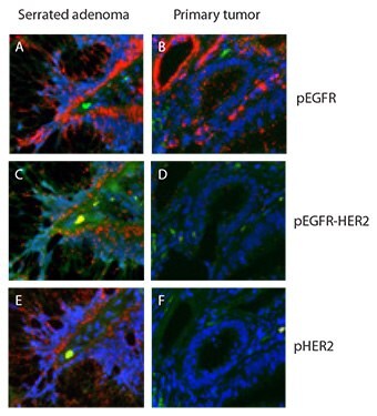 Duolink assay of HER-family dimerization and activation in colon tissue samples. Both samples contained high levels of pEGFR (A,B) but only the serrated adenoma showed high levels of pEGFR‑HER2 complexes (C,D) and of pHER2 (E,F). Red: PLA signals. Green: Sample autofluorescence (to visualize the cell morphology). Blue: nuclei (DAPI).